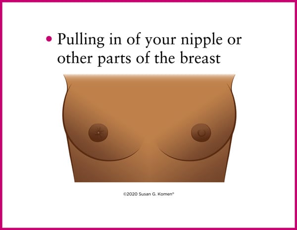 Nipple types and how one means you could have cancer