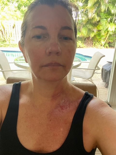 A woman with visible radiation treatment burns on her upper chest and shoulder, sitting indoors near a sliding glass door with a view of a backyard pool and patio furniture. She has a calm expression and is wearing a black tank top.